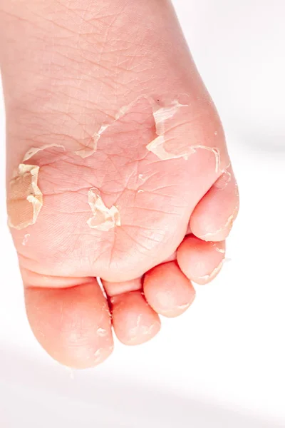 Miután a piros kiütések és az eper nyelve által okozott skarlát az érintett bőr gyakran hámlani kezd-itt bőr láb peeling — Stock Fotó