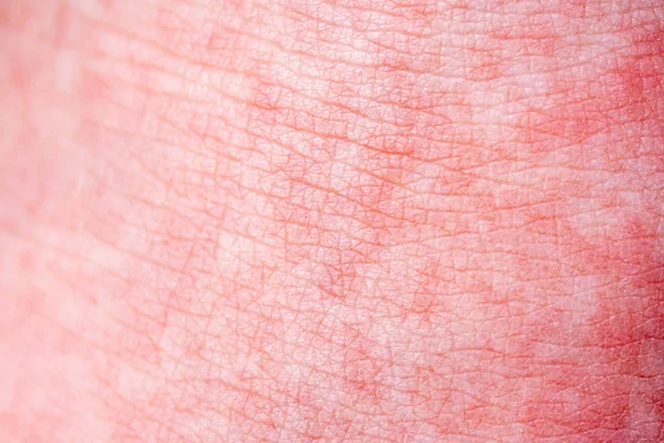Szkarłatna gorączka zaczyna się od czerwonego pośpiechu i języka truskawki potem dotknięta skóra często peelingi-tutaj czerwona skóra pęd — Zdjęcie stockowe