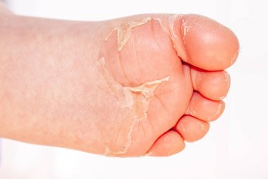 Kırmızı döküntü ve kızıl ateş neden çilek dili sonra etkilenen cilt genellikle peeling-burada ayak soyma cilt