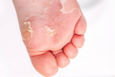 Kırmızı döküntü ve kızıl ateş neden çilek dili sonra etkilenen cilt genellikle peeling-burada ayak soyma cilt