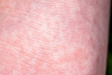 Scarlet Fever kırmızı acele ve çilek dili ile başlar daha sonra etkilenen cilt genellikle peeling-burada kırmızı cilt acele