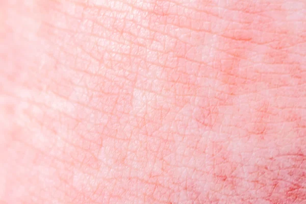 Scarlet Fever starts with a red rush and the strawberry tongue Afterwards the affected skin often peels - Here red skin rush — Stock Photo, Image