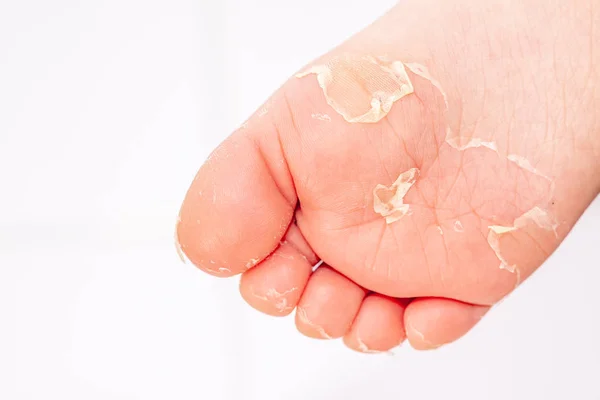 Miután a piros kiütések és az eper nyelve által okozott skarlát az érintett bőr gyakran hámlani kezd-itt bőr láb peeling — Stock Fotó