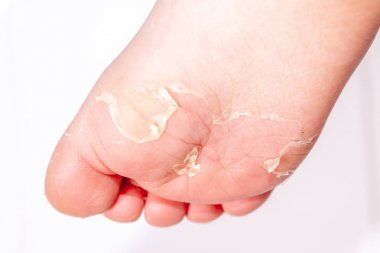 Kırmızı döküntü ve kızıl ateş neden çilek dili sonra etkilenen cilt genellikle peeling-burada ayak soyma cilt