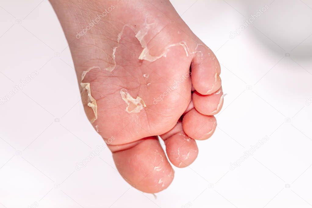 After the red rash and the strawberry tongue caused by scarlet fever the affected skin often peels - Here Skin of foot peeling