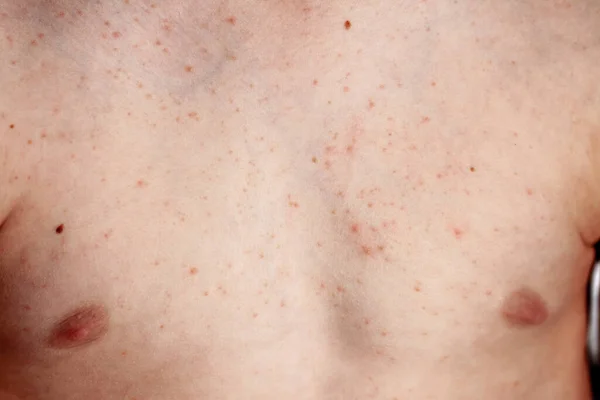 Close up image of a little boys body suffering severe urticaria, nettle rash also called hives — Stock Photo, Image