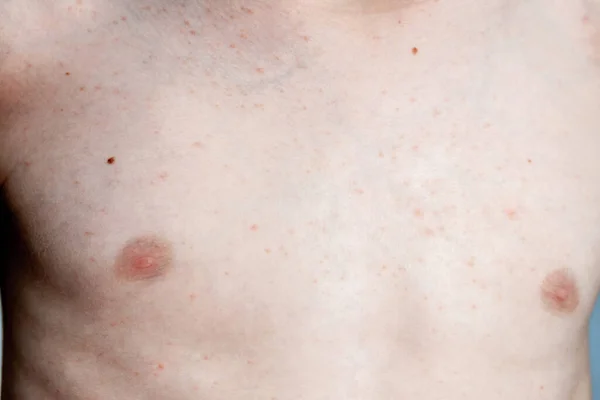 Image rapprochée d'un corps de petits garçons souffrant d'urticaire sévère, éruption cutanée d'ortie également appelée urticaire — Photo