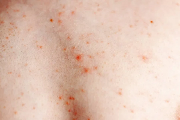 Imagen cercana de un cuerpo de niños pequeños que sufren urticaria severa, erupción de ortiga también llamada urticaria — Foto de Stock