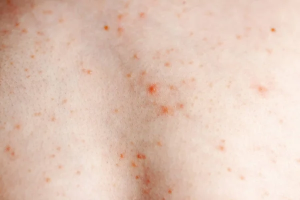 Imagen cercana de un cuerpo de niños pequeños que sufren urticaria severa, erupción de ortiga también llamada urticaria — Foto de Stock