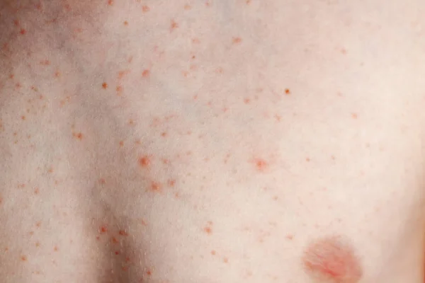 Close up image of a little boys body suffering severe urticaria, nettle rash also called hives — Stock Photo, Image