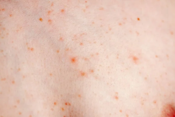 Close up image of a little boys body suffering severe urticaria, nettle rash also called hives — Stock Photo, Image