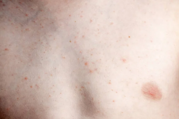 Close-up beeld van een kleine jongens lichaam lijdt ernstige urticaria, netelroos ook wel netelroos — Stockfoto