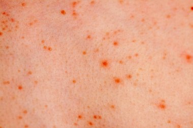 Close up image of a little boys body suffering severe urticaria, nettle rash also called hives clipart