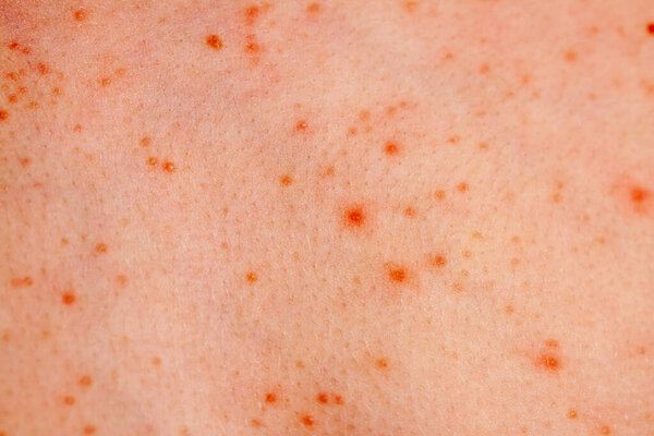Close up image of a little boys body suffering severe urticaria, nettle rash also called hives