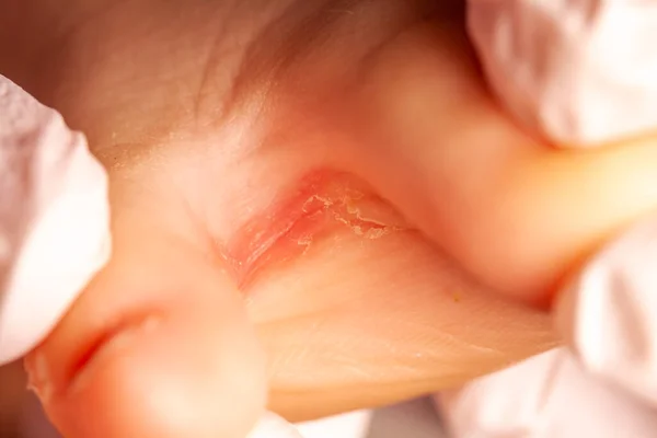 医者の女の子足とともに真菌感染症 — ストック写真