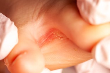 Mantar enfeksiyonu olan doktor küçük kızlar.