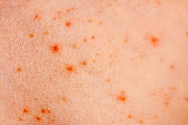 Close-up beeld van een kleine jongens lichaam lijdt ernstige urticaria, netelroos ook wel netelroos — Stockfoto