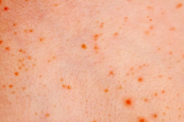 Close up image of a little boys body suffering severe urticaria, nettle rash also called hives — Stock Photo, Image