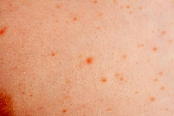Close up image of a little boys body suffering severe urticaria, nettle rash also called hives — Stock Photo, Image