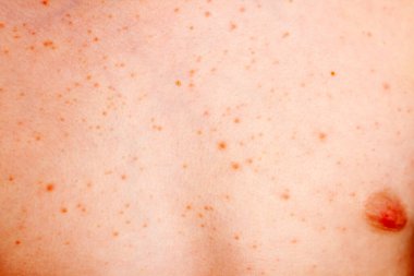 Şiddetli ürtizi olan küçük bir çocuğun vücudunun yakın görüntüsü, ısırgan otu isiliği de kovan olarak bilinir.