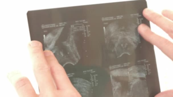 Vista Ravvicinata Medico Caucasico Che Esamina Una Radiografia — Video Stock