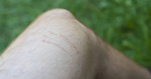 Травма Кішки Подряпини Шкірі Ноги Людини — стокове фото