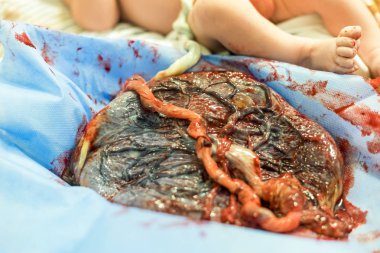 Placenta outside uterus just after childbirth and the baby in the background clipart