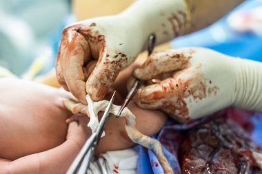 Babası bir yeni doğan bebek ve plasenta arasındaki göbek kordonu keser