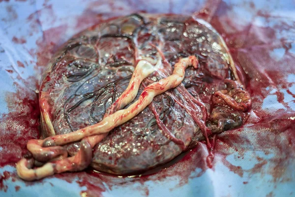 Placenta Buiten Baarmoeder Net Bevalling Het Ziekenhuis — Stockfoto