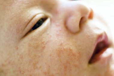 Yeni doğan bebek çocuk yüz tarafından atopik dermatit neden birçok sivilce ile