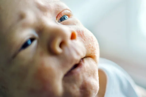 Newborn Baby Boy Face Many Red Pimples Caused Atopic Dermatitis — Stock Photo, Image