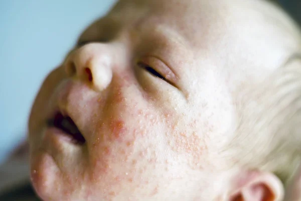 Newborn Baby Boy Face Many Red Pimples Caused Atopic Dermatitis — Stock Photo, Image