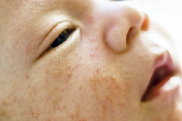 Newborn Baby Boy Face Many Pimples Caused Atopic Dermatitis — Stock Photo, Image