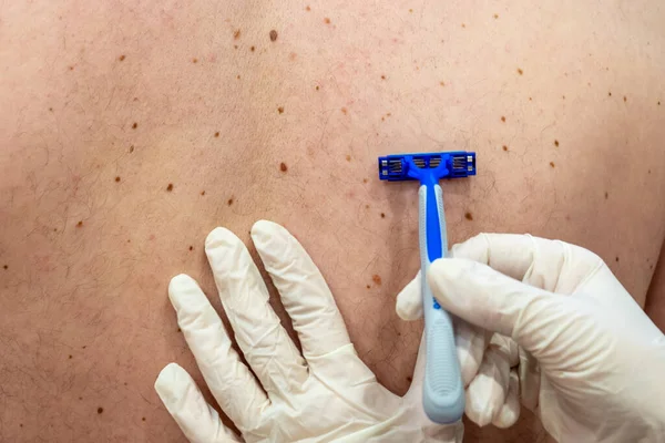 A female cosmetologist shaves her back with a disposable razor, the process of preparing the skin for laser surgery — Stock Photo, Image