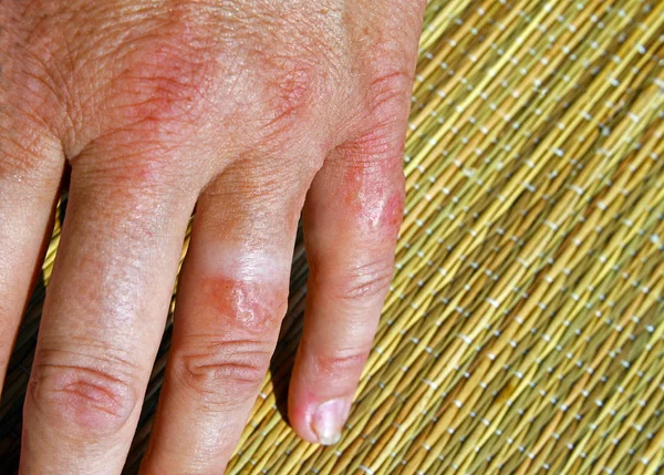 Женские пальцы на руке поражены медузой. Стоковое Изображение