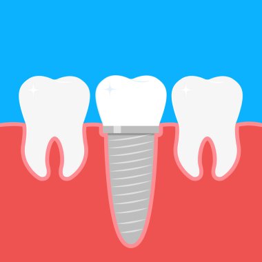 İnsan dişleri ve Dental implant. Hisse senedi vektör çizim