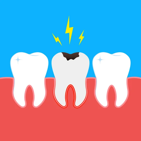歯齲蝕 歯科損傷 痛みイラストベクトル — ストックベクタ