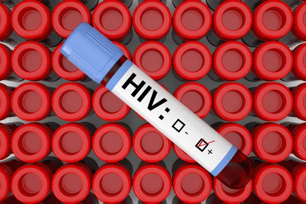 Bloedtest kolf buis met HIV positief resultaat over rijen van de test — Stockfoto