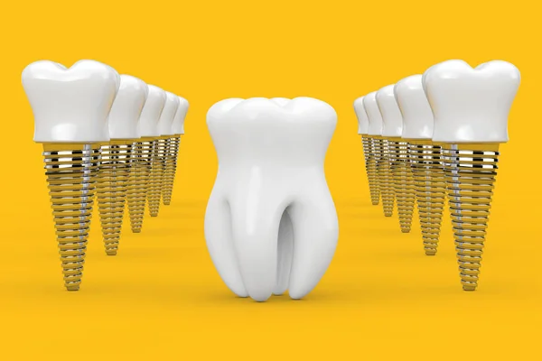 Dente saudável pré-molar entre linhas de implantes dentários. Render 3d — Fotografia de Stock