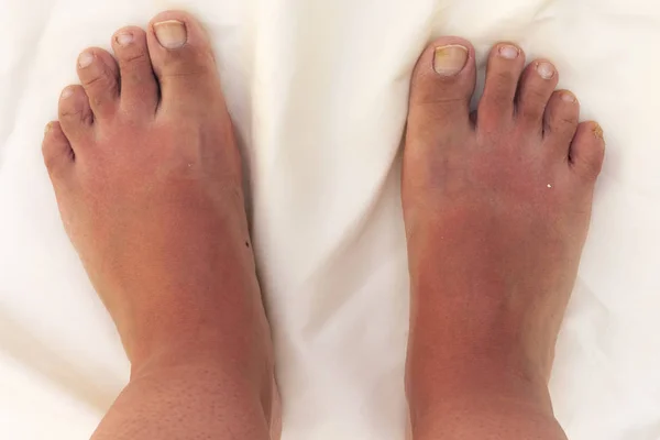 Güçlü güneş yanığı. Tan ağrı hastalığı yanma kaşıntı döküntü yanık