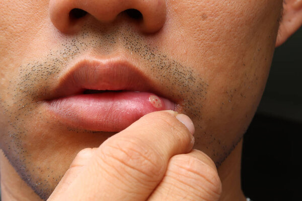 aphthous stomatitis ,lip leison.