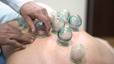 Akupunktur terapist bir fincan bir erkek hasta, Antik Çin alternatif tıp arkasına yerleştirerek. Genç adam sırt üstü çukurluğu tedavi veren bir doktor için yakın çekim.