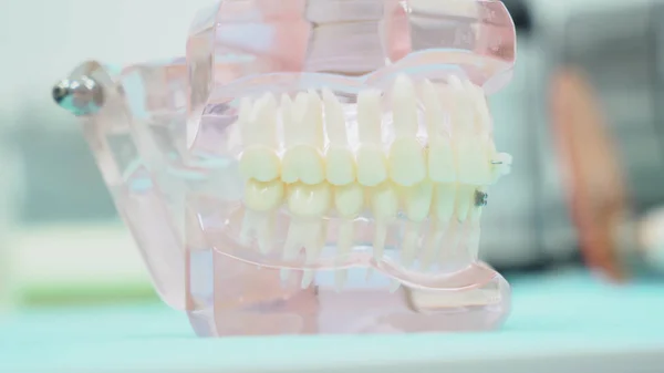 Крупним планом зубна щелепа. Медіа. Стоматологія щелеп з зубами з прозорими яснами стоїть на столі в стоматологічному кабінеті. Сучасний дизайн протезу щелепи — стокове фото