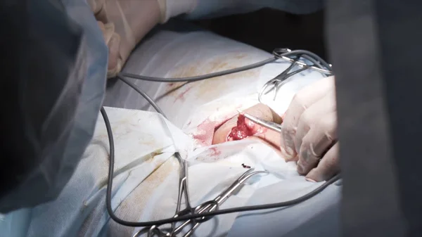 Κοντινές λεπτομέρειες μιας χειρουργικής διαδικασίας σε ένα αποστειρωμένο δωμάτιο. Πάμε. Γιατροί με γάντια ασφαλείας που εκτελούν εγχειρήσεις με χειρουργικά εργαλεία και σώζουν ζωές ασθενών, ιατρική έννοια. — Φωτογραφία Αρχείου