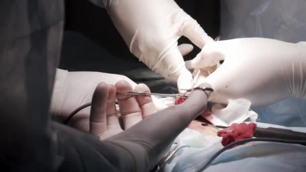 Surgical team operating male genitals in an operation theater. Action. Close up of surgeons removing the tumor from the testicle of a man patient, cancer and medicine concept. — Stock videók