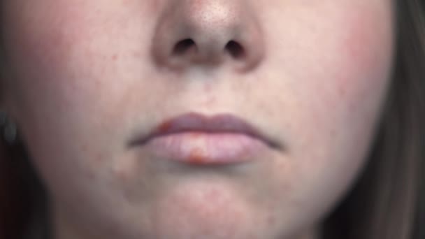 Close-up of female problem skin with herpes on lips. Media. Well-groomed skin of face with black spots and inflammation on lips. Poor or improper skin care can lead to inflammation — Stock Video