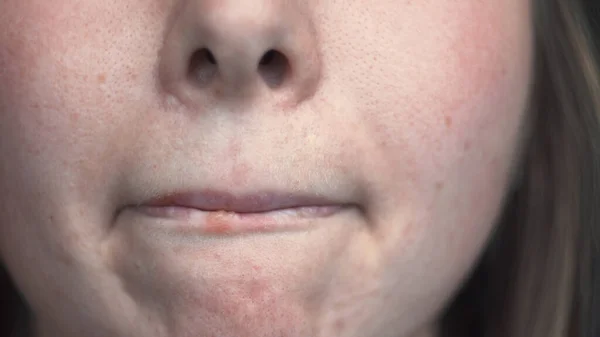 Gros plan sur les problèmes de peau féminins avec herpès sur les lèvres. Les médias. Peau bien soignée du visage avec des taches noires et inflammation sur les lèvres. Mauvais ou mauvais soin de la peau peut conduire à l'inflammation — Photo