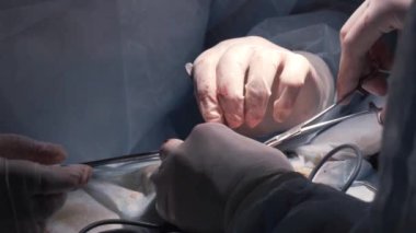 Karmaşık ameliyatlar yapan doktorların elleri. Başla. Profesyonel cerrahlar anestezi altında ameliyat yaparlar. Cerrahlar hastalıkları veya yaraları iyileştirmek için ameliyat yaparlar.