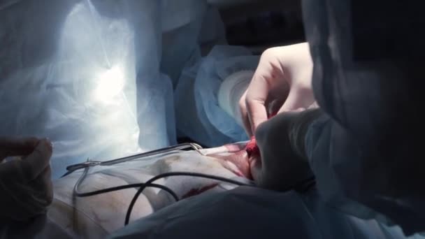 Close-up of surgeons operating on inside of person. Action. Complex surgical operation on entrails under anesthesia. Removing illness or correcting injury in operating room — Stock Video