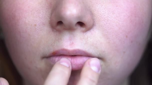 Giovane donna che soffre di herpes sulle labbra. I media. Primo piano delle dita delle donne che applicano unguento sulle labbra, trattamento dell'infezione da herpes e virus. — Video Stock